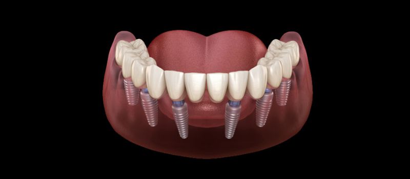 dental implants singapore cost
