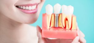 Dental Implants